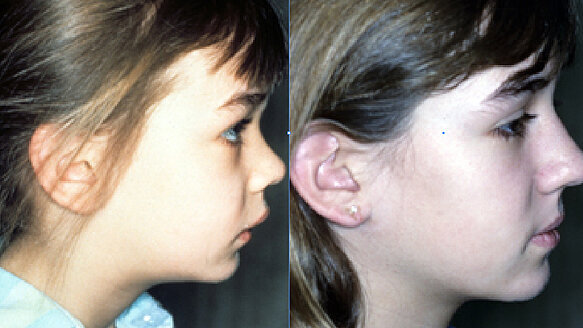 Results for Nite-Guide preventive and interceptive procedure