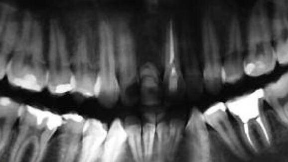 Przypadki rekonstrukcji implantoprotetycznej – obserwacje kilkuletnie