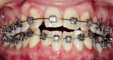 Nechirurgická léčba anomálií III. třídy s agenezí laterálních řezáků