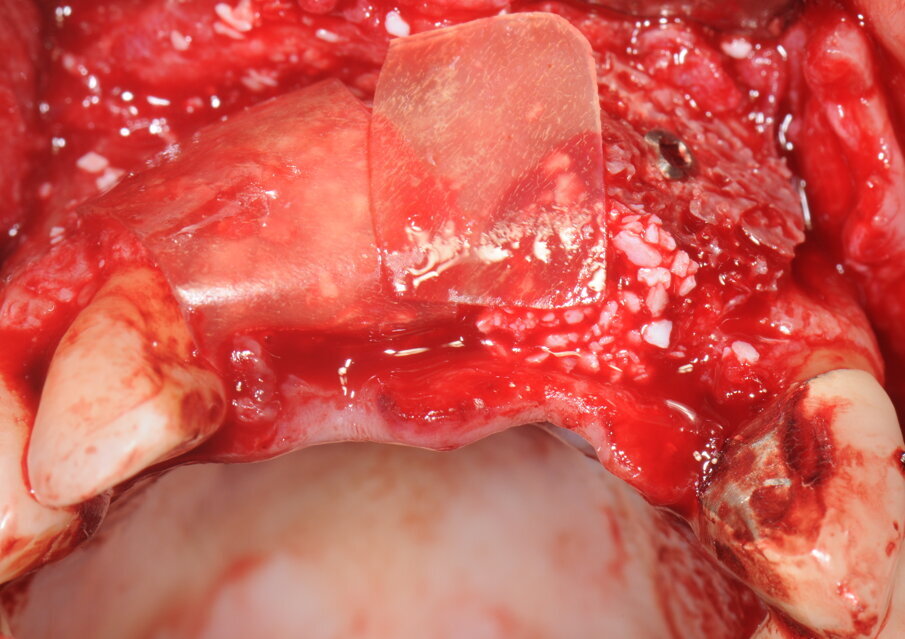 Fig. 10 - Apposizione delle membrane Lamina Tecnoss®.