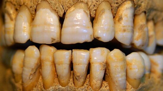 Ipoplasia dello smalto in un soggetto proveniente da un sito tardo medievale di Volpiano (To)