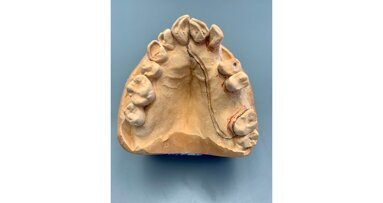 POM: een nieuwe speler op het terrein van uitneembare prothetische voorzieningen