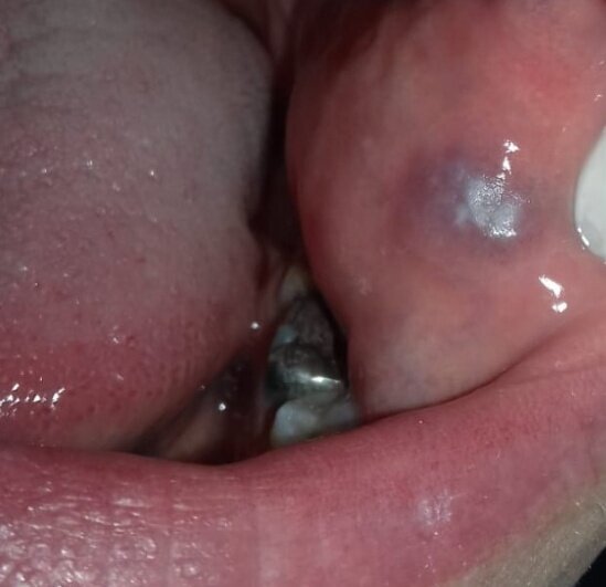 Fig. 3 - Reazione pigmentata da contatto all’amalgama della mucosa orale.