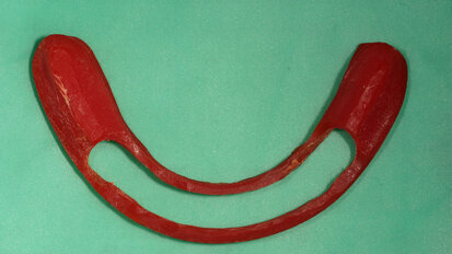 Fig. 1. Barra de Duralay® OSU, modelo rígido donde se fabrica la barra y barra metálica colada. Fig. 1. Barra de Duralay® OSU, modelo rígido donde se fabrica la barra y barra metálica colada.