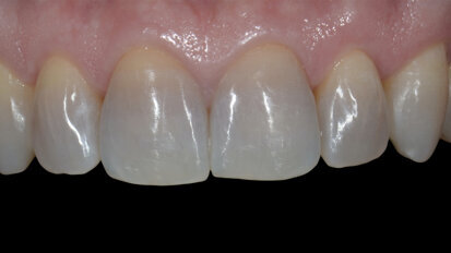Aesthetic restoration of discoloured anterior teeth using feldspathic porcelain veneers