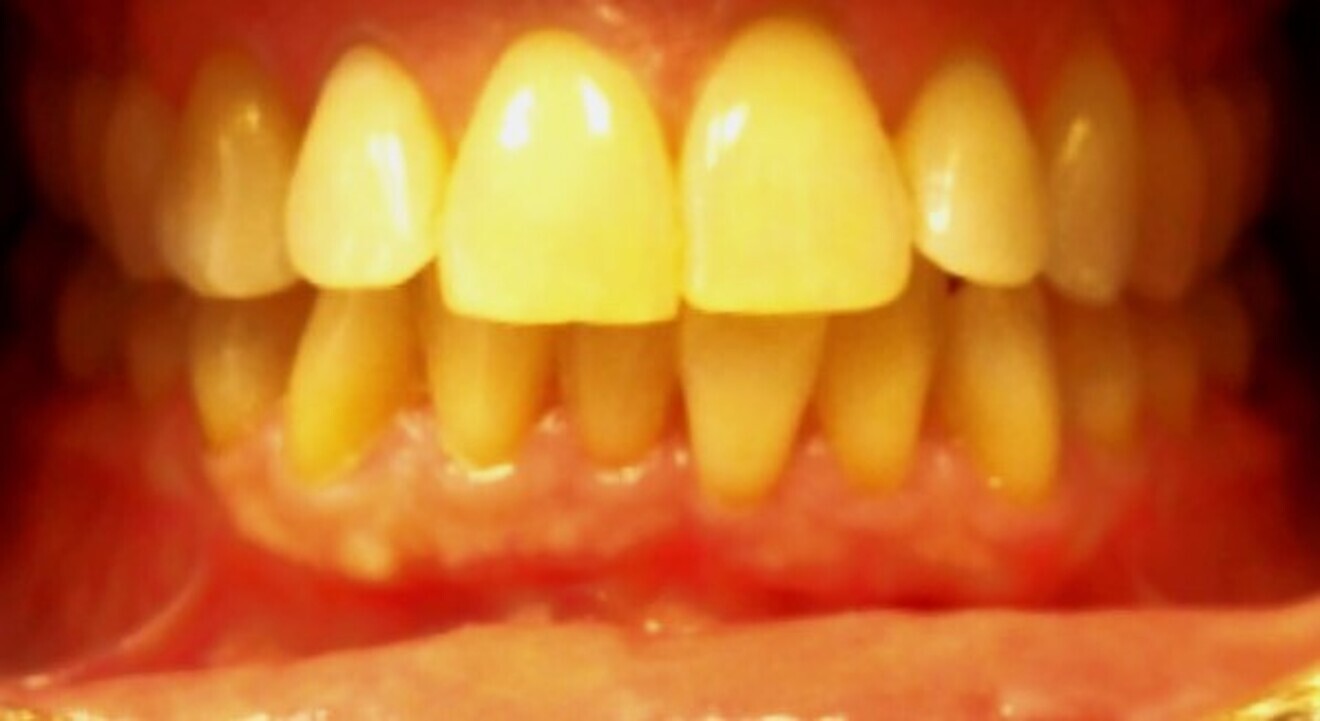 Fig. 7: Crowding and overjet in a 54-year-old female patient.