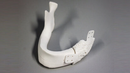 Neuartiger Knochenersatz soll Knochen zum Wachsen anregen Neuartiger Knochenersatz soll Knochen zum Wachsen anregen