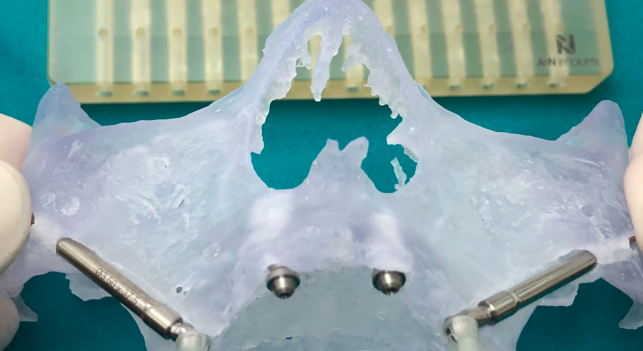 Figg. 27, 28 - Fine intervento: perfetta pianificazione dal modello stereolitografico al risultato finale.