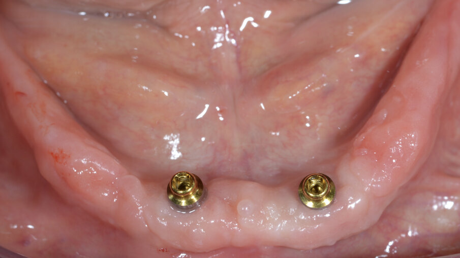 Fig. 4_Overdenture mandibolare. Soluzione pratica e affidabile in pazienti con scarsa igiene orale.