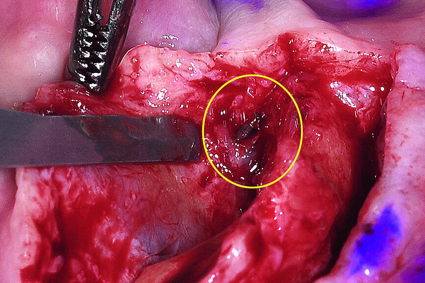 Fig. 14: The broken drill was located lingual to the bony crest of the mandible.