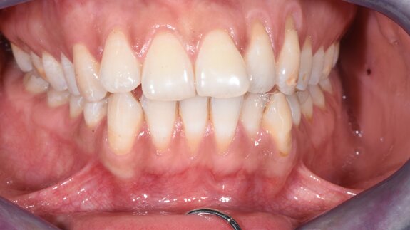 La gestione dell’IPR nei casi ortodontici con allineatori trasparenti