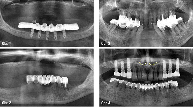 Obr. 1: V interforaminální oblasti zůstane téměř vždy dostatek kosti pro Brånemarkův můstek  Obr. 2: Ani v laterálních úsecích mandibuly nehraje výrazná resorpce kosti způsobená prolongovanou parodontologickou terapií významnou roli  Obr. 3: Resorpce alveolárního výběžku v laterálních úsecích maxily způsobená ponecháním eliminujících se zubů není zásadní překážkou  Obr. 4: Nabídka kosti v interantrální oblasti je limitující. Frontální zuby měly být u tohoto kandidáta implantační terapie včas odstraněny (spodina dutiny nosní).