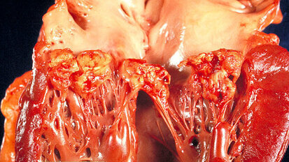 Endocarditis risk: Many German dentists ignore guidelines