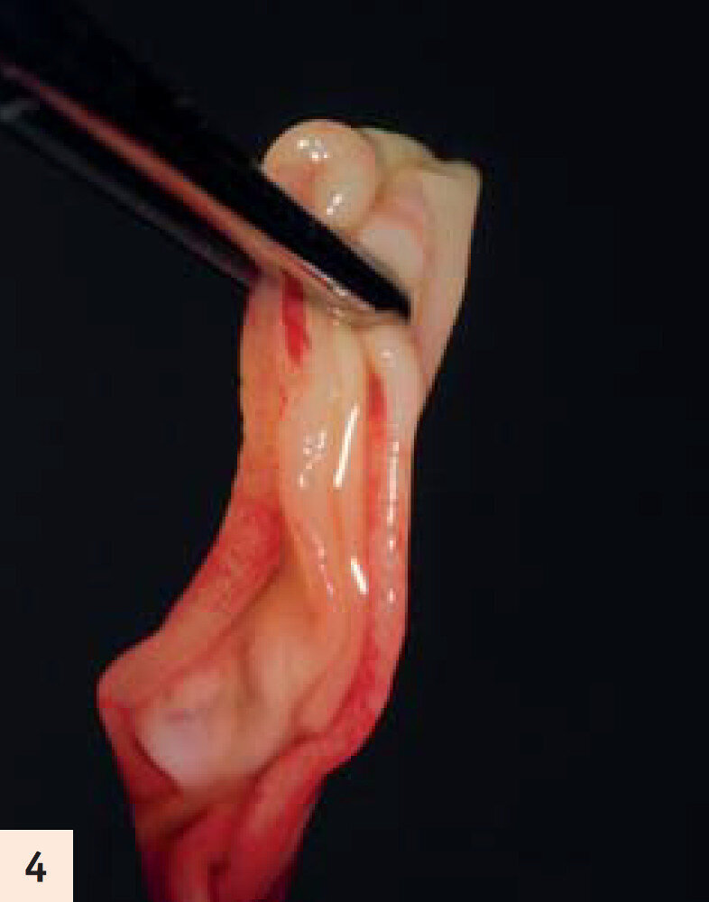 figure 4 : Manipulation d’une membrane d’A-PRF. Les membranes préparées sont prêtes à être insérées sous le lambeau. Trois ou 4 membranes par couple de dents offrent un volume et une libération cellulaire adéquates