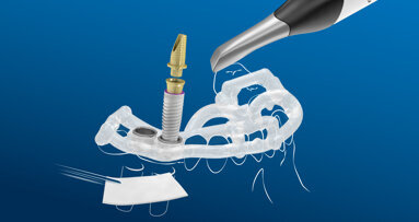 Making implantology simple with the MIS digital workflow