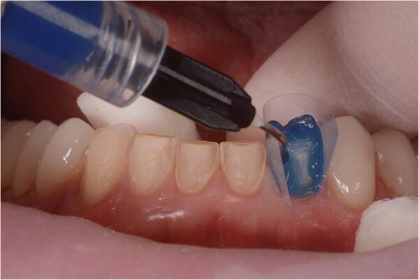 Fig. 13. Las coronas (#11-13 y 21-23) y las carillas (#14-17, 24-27, 31-37 y 41-47) se cementaron a los pilares utilizando un cemento de resina fotopolimerizable (Futurabond U y Bifix QM).