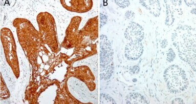 Pesquisadores encontram mutação em tumor do maxilar