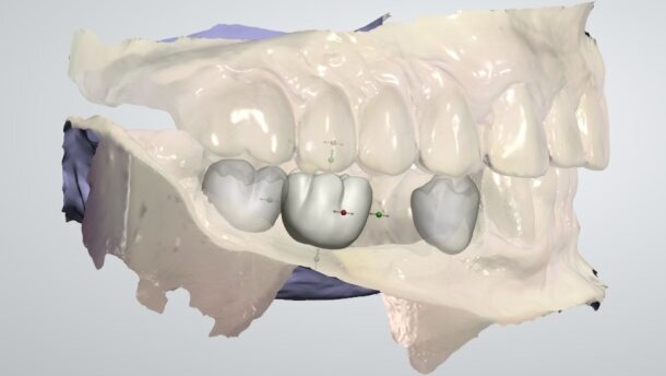 Wykorzystanie możliwości technologii CAD/CAM na etapie planowania i leczenia – aspekty techniczne