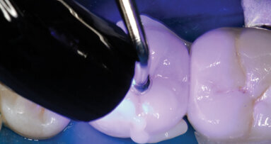Cementation of restorations: A new luting composite