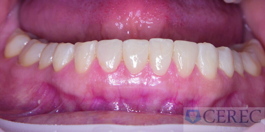 Fig. 9: Image after fitting the veneers.