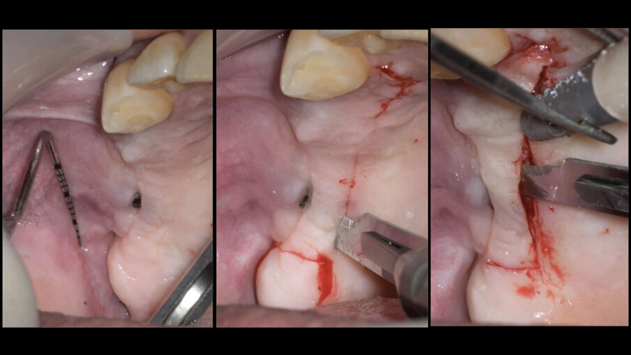 Fig. 14 - Incisione palatale a spessore parziale finalizzata alla seconda fase implantare con vestiboloplastica.