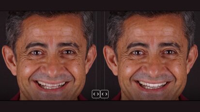 Colocación de restauraciones cerámicas adhesivas en la zona estética (1)