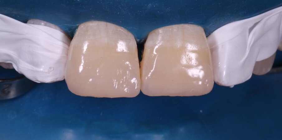 Fig 13: Final layer of Enamel Shade composite covering the entire bevel