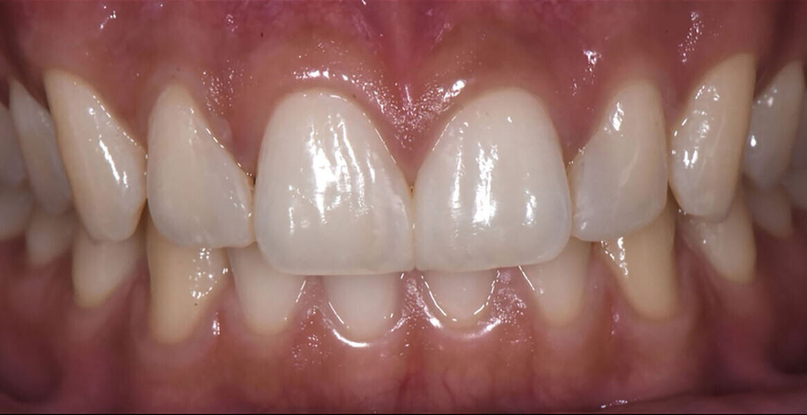 Fig. 21b: Six-month follow-up.