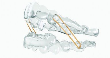 Ormco announces the launch of Spark Retainers and Spark BiteSync Class II Corrector system