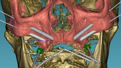 Rehabilitatie van edentaten: implantaten met remote verankering bij patiënten met zeer ernstige atrofische maxilla