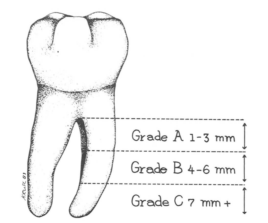 Fig. 5c - Suddivisione grado interessamento verticale della biforcazione.