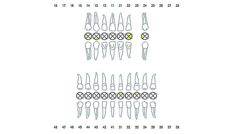Οξεία περιοδοντίτιδα και αρνητική κλινική πορεία σε ασθενείς με κίρρωση του ήπατος.