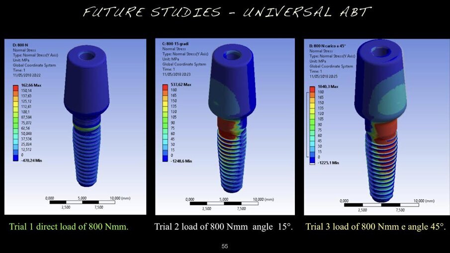 Fig. 12a - Von Mises results at the, universal abutment system prosthesis.