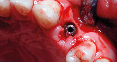 Il laser in implantologia: azioni e vantaggi. Analisi dell’utilizzo dei laser in chirurgia dopo 15 anni di follow-up dalla fondazione di AIOLA, fatti e certezze