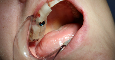 Implantacja natychmiastowa z szablonem drukowanym 3D