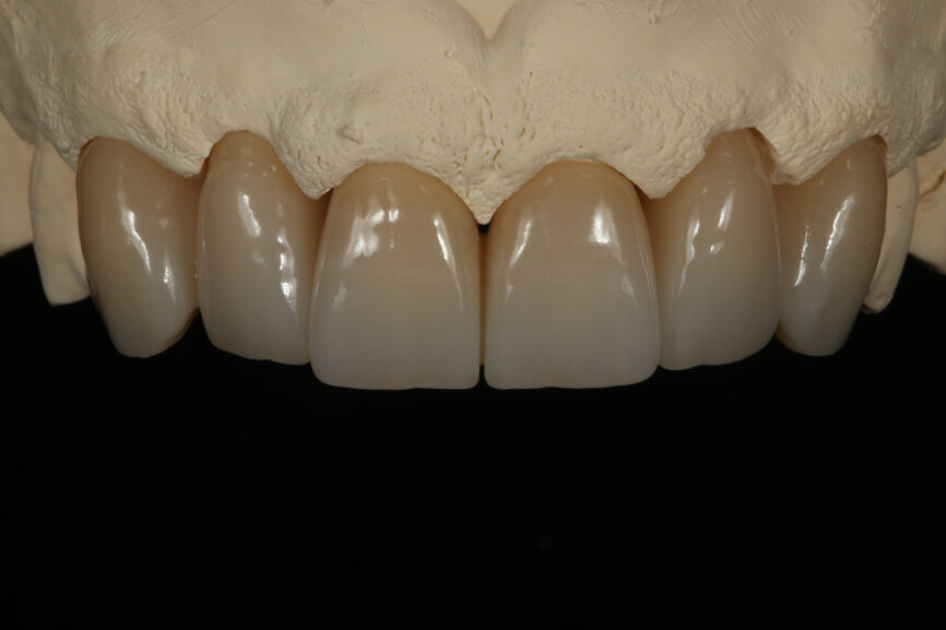 Fig. 4: Restorations after porcelain layering.