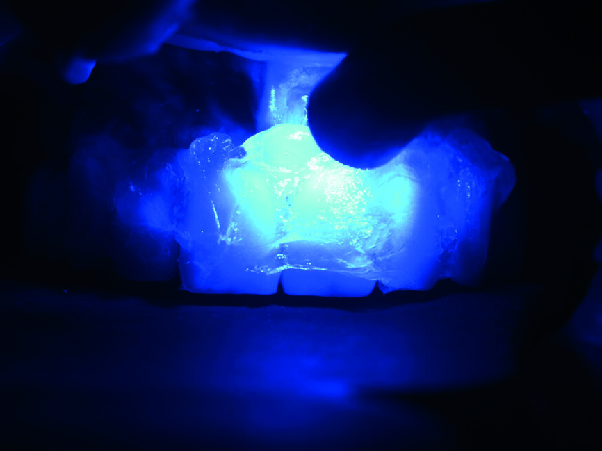 Fig. 14 : Photopolymérisation des limites marginales prothétiques des couronnes en zircone au travers d’une barrière à l’oxygène.