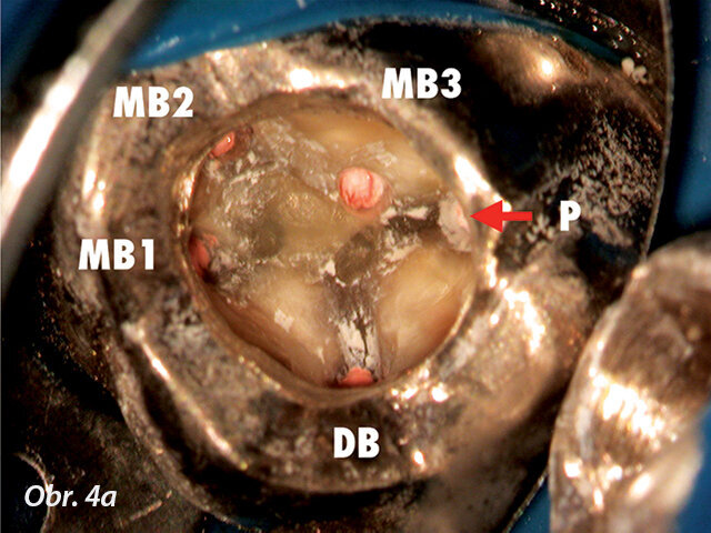 Situace po ireverzibilní pulpitidě u levého horního moláru dva týdny po nasazení fixní částečné náhrady. Vysoké zvětšení umožnilo identifikaci a ošetření tří meziobukálních kanálků skrz stávající náhradu.
