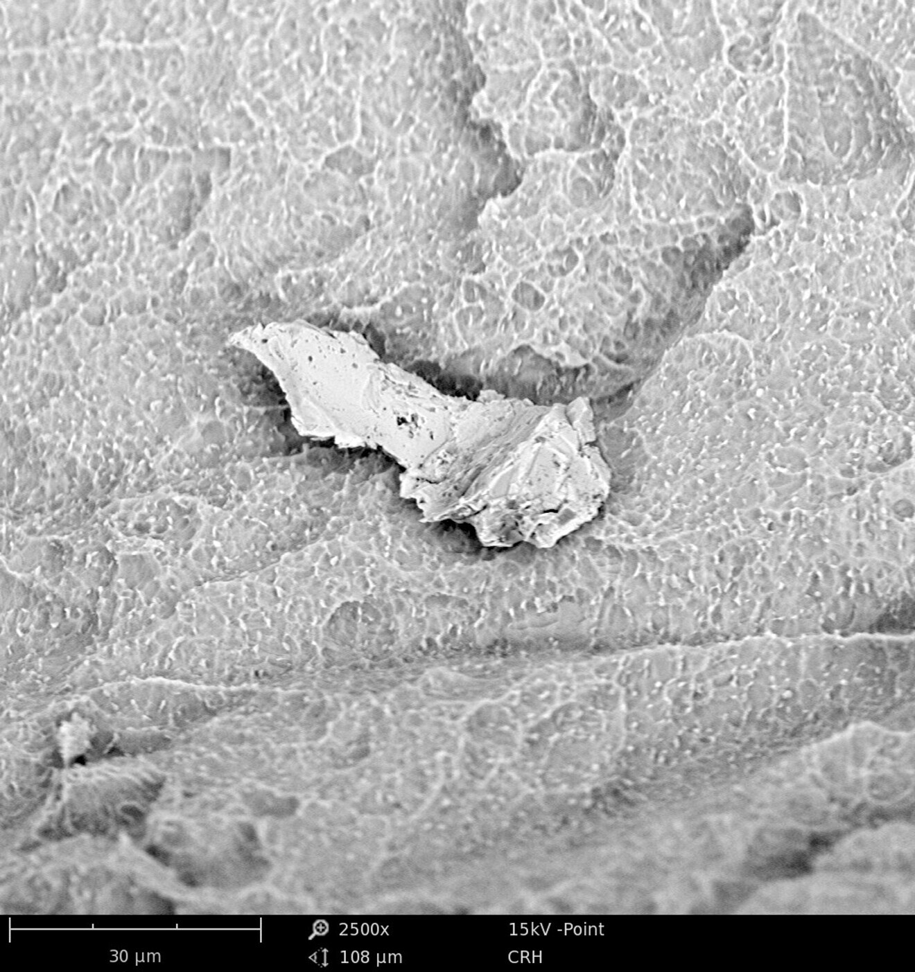 Fig. 1: Metal particle of iron, chromium and nickel on the surface of a titanium implant (Adin). SEM 2,500× magnification.