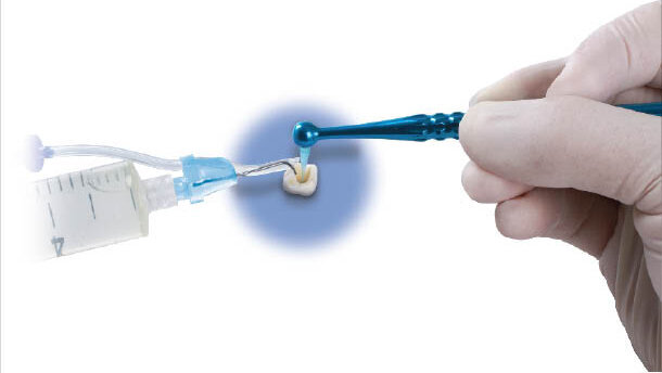 EndoVac system – nová dimenze výplachů v endodoncii