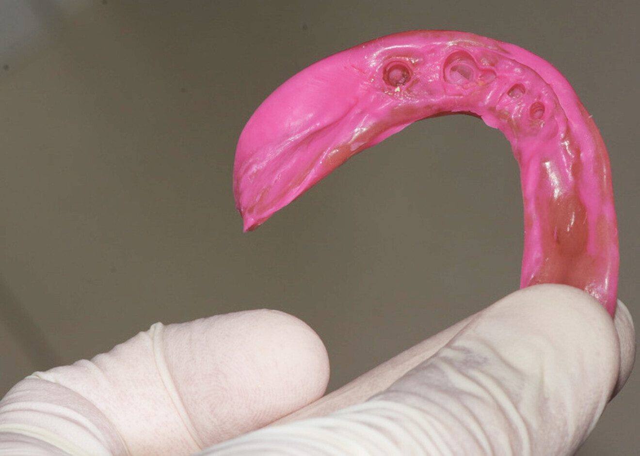 Fig. 3: Taking of the mandibular impression with the existing denture.