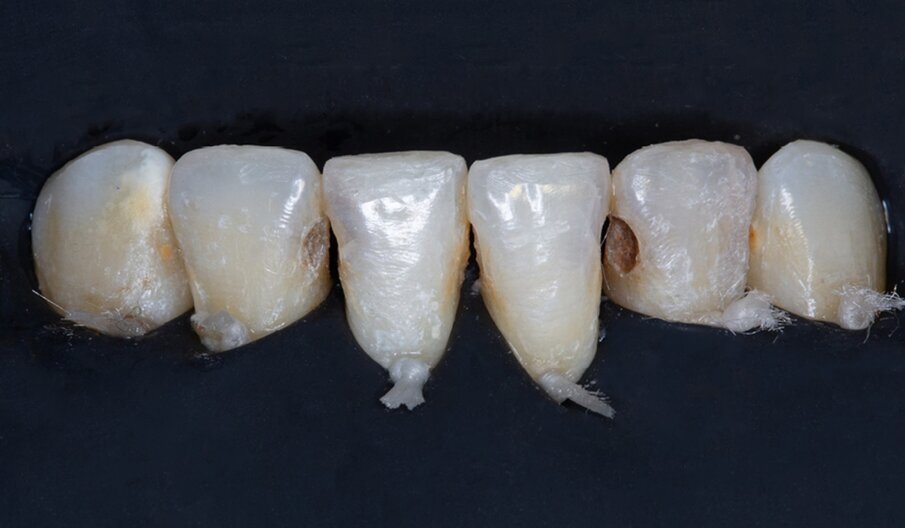 Fig. 2: Situation after placement of a dental dam for moisture control.