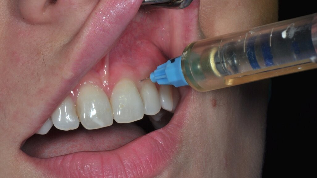 Korak dalje – lokalna anestezija ili paraformaldehid?