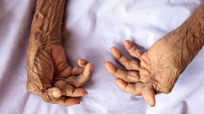 Pacientes com artrite reumatoide avaliam como a saúde bucal afeta a qualidade de vida