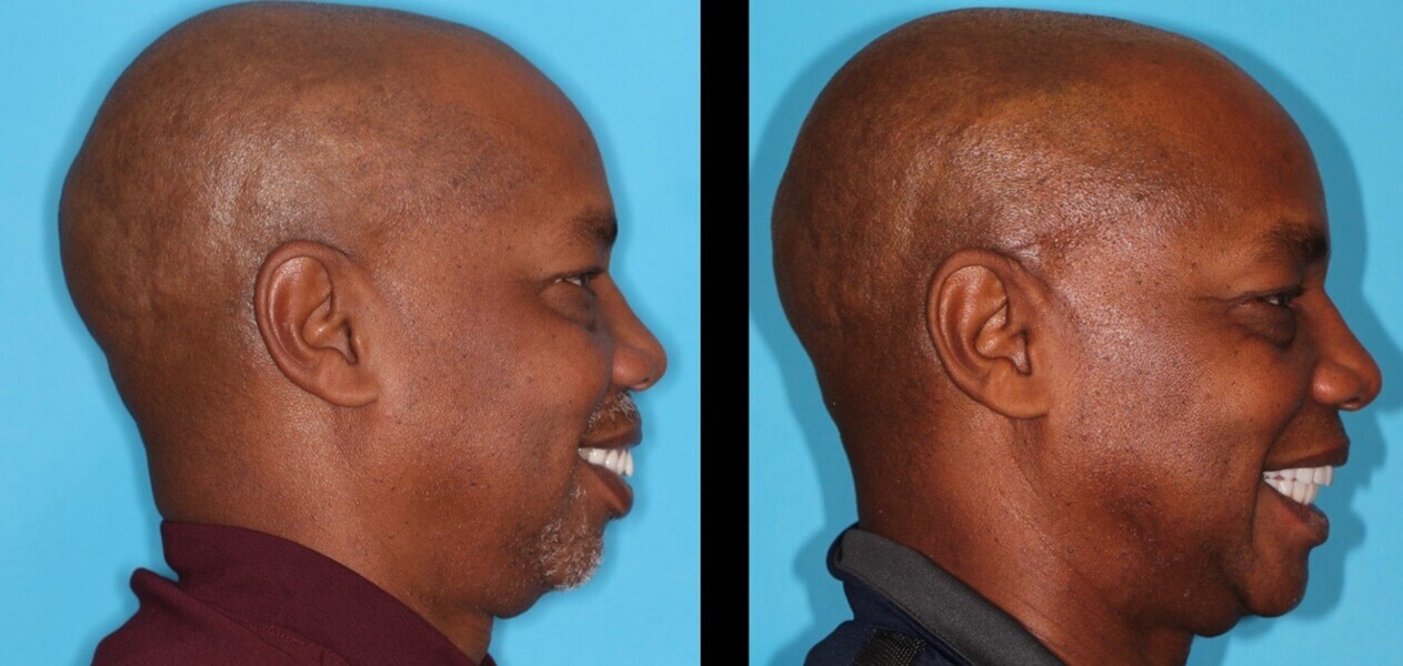 Figs. 39a & b: Before (a) and after profile views (a) showing improved lower facial third proportion and autorotation of the mandible.