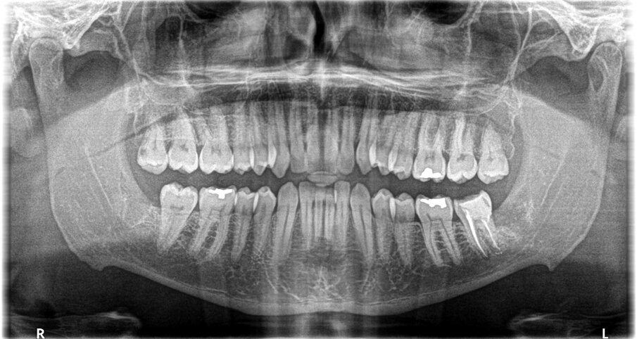 Fig. 2 - Immagine rx di controllo postoperatoria.