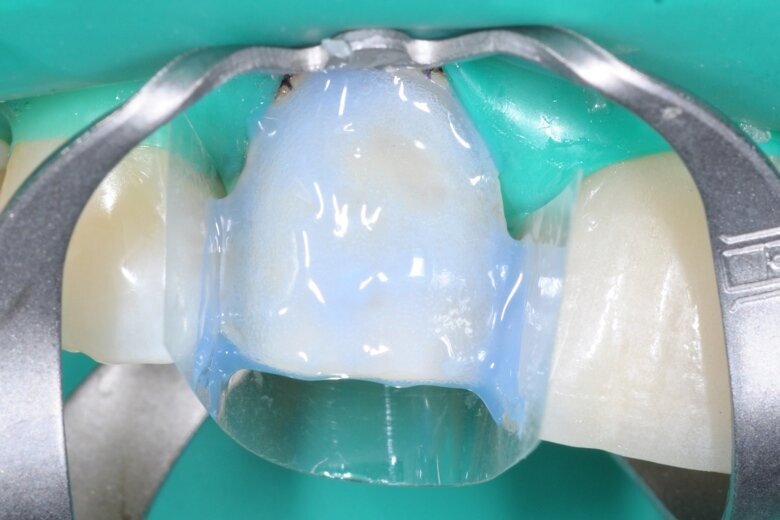Fig. 14 Etching with 35% phosphoric acid K-ETCHANT Syringe (Kuraray Noritake Dental) for 10 seconds.