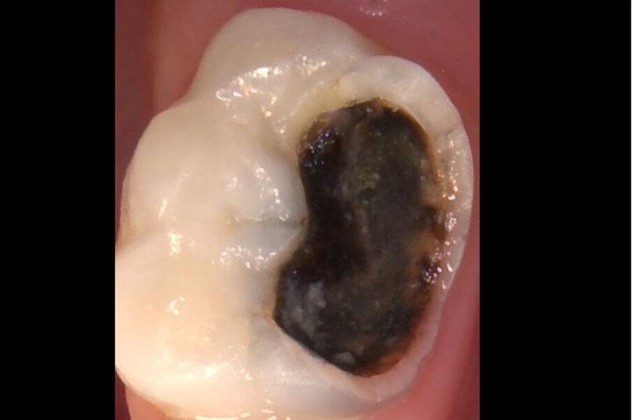 Afbeelding 2. Casus 1: 13-03-20. Na 4 maanden zwart verkleurd en symptoomvrij met vitale pulpa.