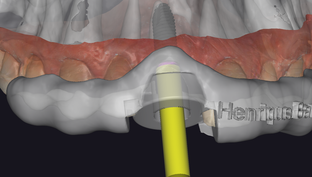 Fig. 9b: Virtual surgical guide design in exoplan with a sleeve for implant placement, anterior view.