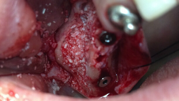 Rialzo del seno mascellare e contestuale inserimento di impianti